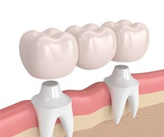 dental bridge 3D rendering