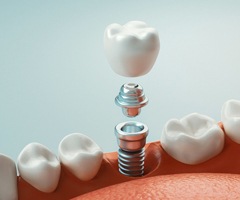 Crown, abutment, implant