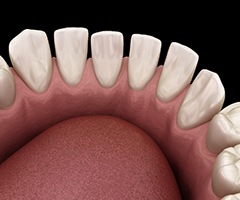 Digital image of a bottom row of teeth that have significant spacing between them and need Invisalign in Charlottesville