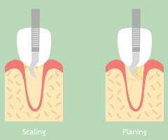 Animation of scaling and root planing treatment
