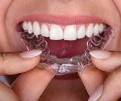 Woman inserting clear aligner into her mouth.