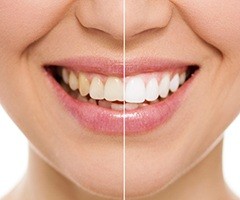 Closeup of teeth half before and half after whitening