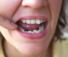 A woman pointing to her crowded teeth in the lower portion of her mouth