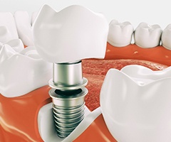 A single tooth implant