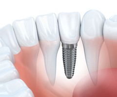 Animated implant supported replacement tooth