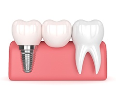 Illustration of implant-retained cantilever dental bridge beside natural tooth