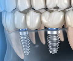 Illustration of implant-retained dental bridge replacing three teeth