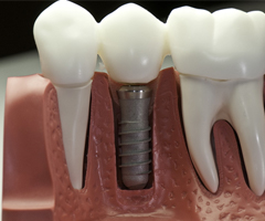 Dental Implants