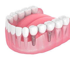 Dental implant bridge