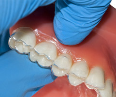 clear aligner on teeth