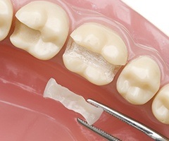 Close up of tooth model with inlay restoration