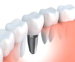 Dental implant