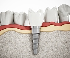 model of dental implant